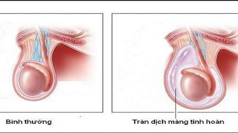 Hình ảnh tràn dịch màng tinh hoàn ở trẻ sơ sinh