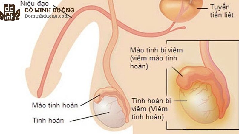 Đau bụng dưới và tinh hoàn thường do viêm tinh hoàn