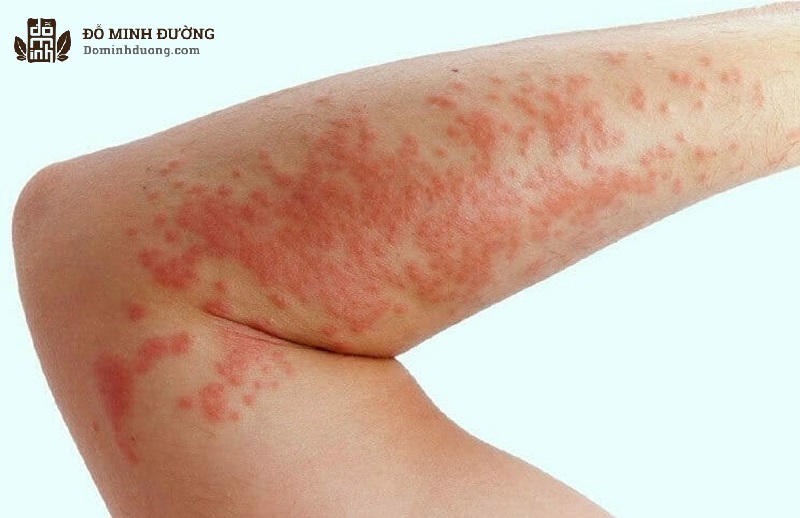 Nổi mề đay cũng gây phát ban đỏ trên da