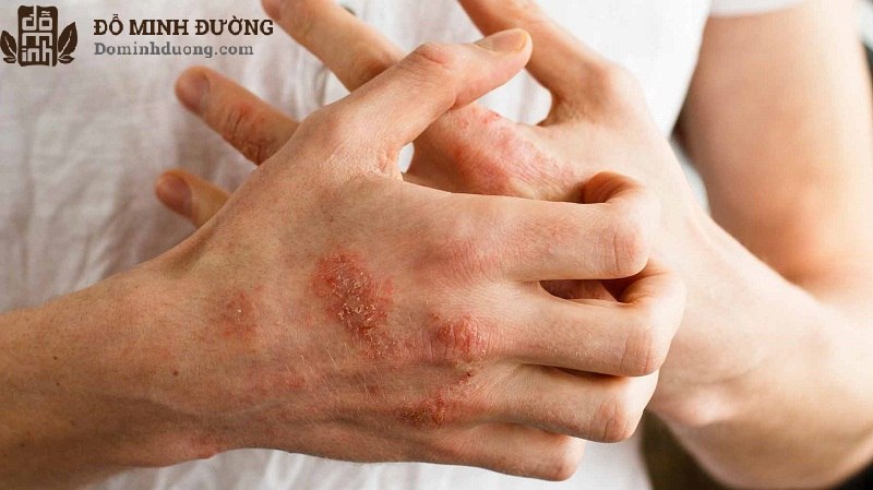 Không nên gãi khi bị mẩn ngứa nhằm tránh làm tổn thương da và viêm nhiễm