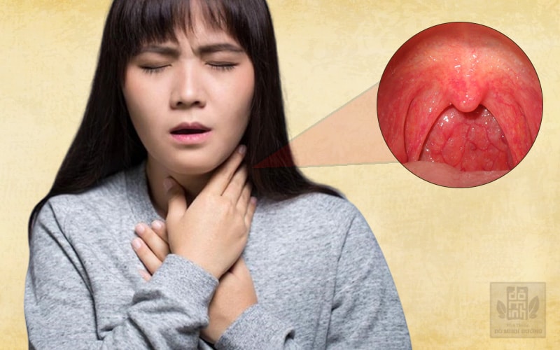 Viêm họng - bệnh lý về đường hô hấp phổ biến ở mọi đối tượng