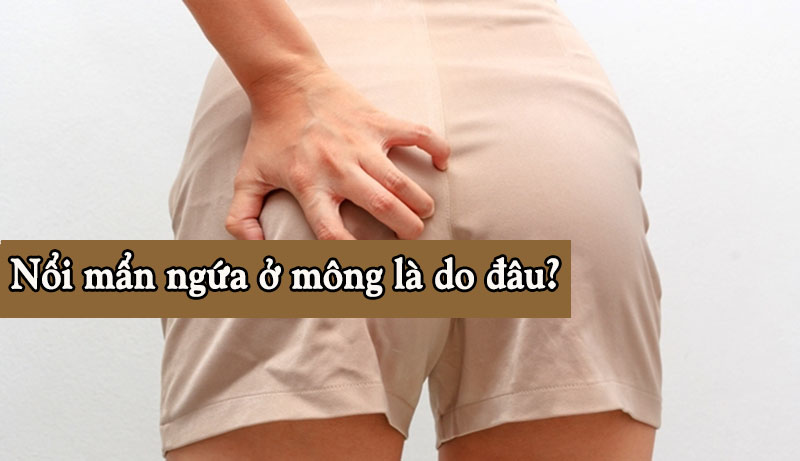 Nổi mẩn ngứa ở mông có thể là do nhiễm nấm, nhiễm khuẩn ngoài da