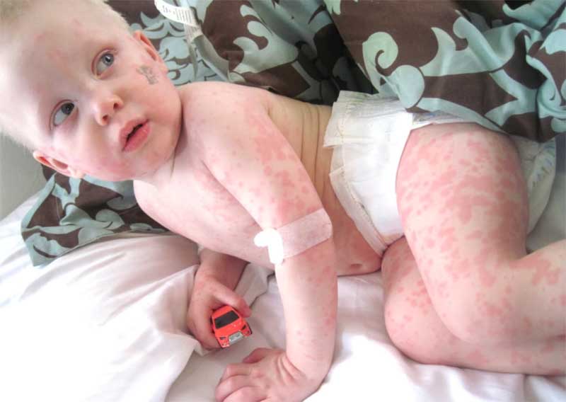 Bé nổi mẩn đỏ khắp người sau sốt là dấu hiệu bị mắc bệnh nhiễm trùng
