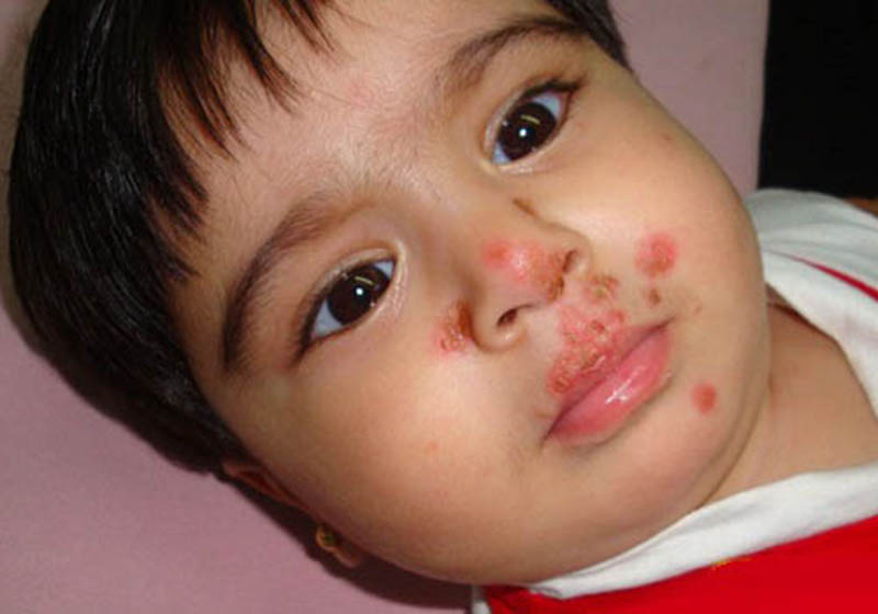 Chốc lở là một trong những nguyên nhân khiến trẻ nổi mẩn đỏ xung quanh miệng