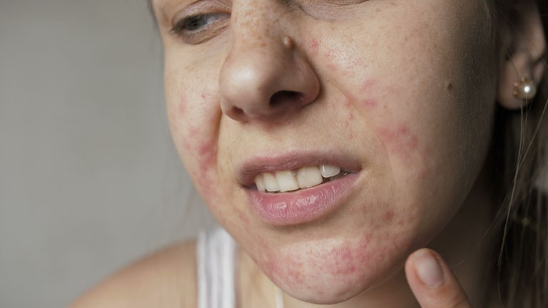Dị ứng da mặt mẩn đỏ ngứa là hiện tượng phổ biến, có thể xảy ra với bất cứ ai