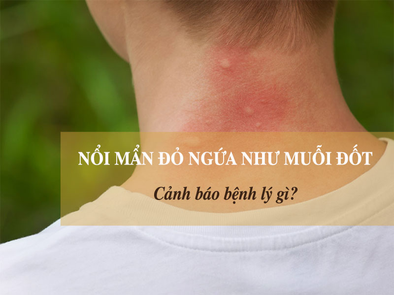 Nổi mẩn đỏ ngứa như muỗi đốt có thể do những yếu tố bên ngoài hoặc các bệnh lý bên trong