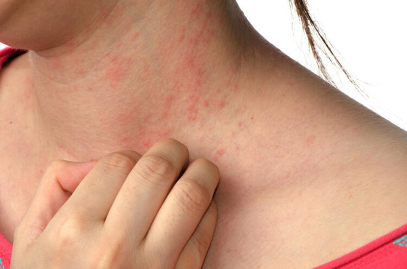 Nổi mề đay ở cổ là một bệnh ngoài da phổ biến, thường xảy vào lúc giao mùa