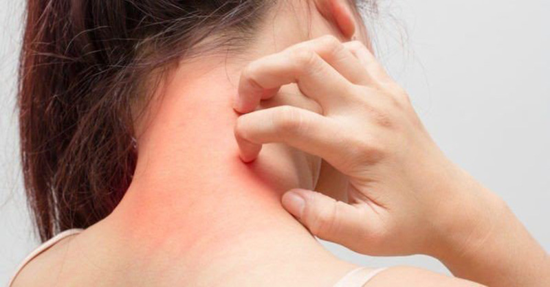 Triệu chứng điển hình của nổi mề đay ở cổ là các nốt mẩn đỏ gây ngứa ngáy