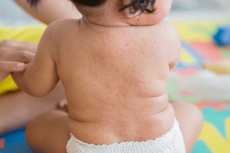 Tình trạng trẻ sơ sinh bị nổi mẩn đỏ ở lưng có thể xảy ra do nhiều nguyên nhân