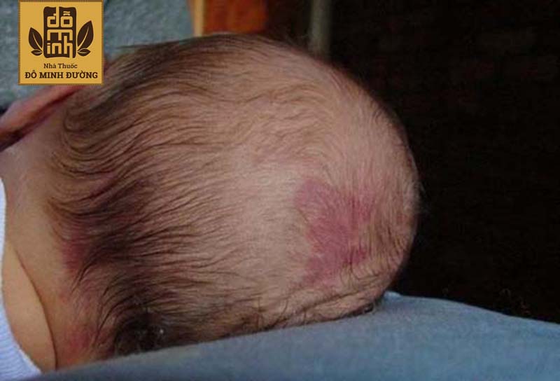 Trẻ sơ sinh bị nổi mẩn đỏ ở đầu có thể do bị sốt phát ban