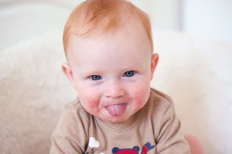 Trẻ bị nổi mẩn đỏ xung quanh miệng là tình trạng cực kỳ phổ biến mà bé nào cũng từng ít nhất một lần mắc phải