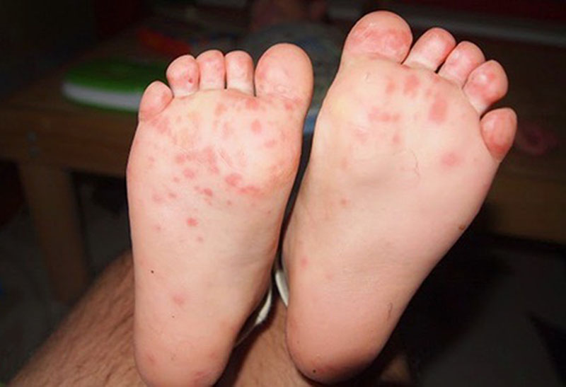 Trẻ sơ sinh bị nổi mẩn đỏ ở chân có thể là do bị tổ địa