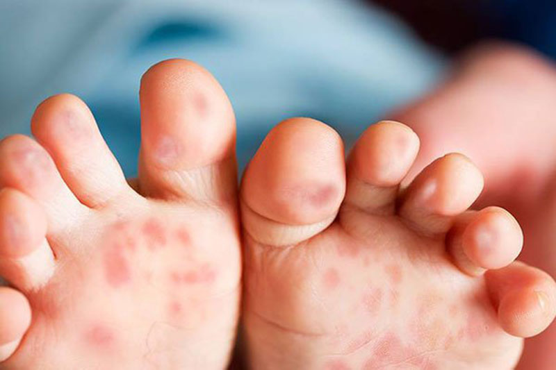 Trẻ sơ sinh bị nổi mẩn đỏ ở chân là hiện tượng phổ biến, xảy ra do nhiều nguyên nhân