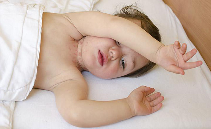 Trẻ sơ sinh bị nổi mẩn đỏ ở cổ là hiện tượng bình thường, dễ gặp