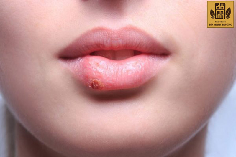 Nguyên nhân gây nổi mề đay sưng môi có thể là do dị ứng, do u nhầy...