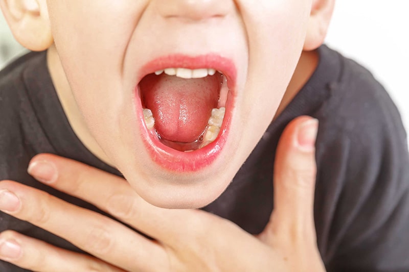 Trẻ bị viêm mũi VA vô cùng phổ biến hiện nay