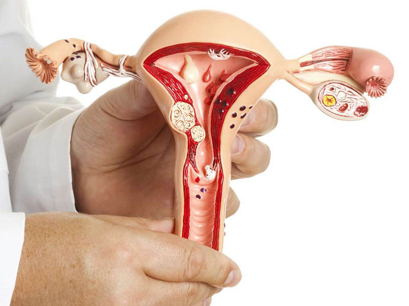 Các bất thường tại tử cung là nguyên nhân trực tiếp dẫn đến tình trạng vô sinh mà nữ giới gặp phải