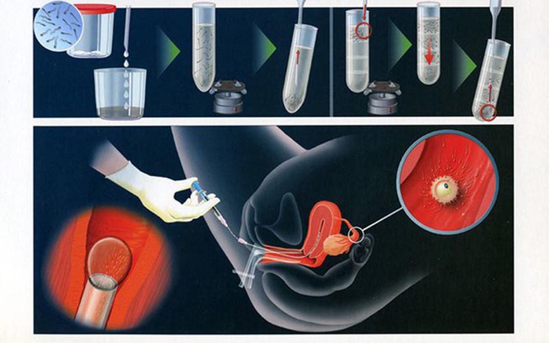 Thụ tinh nhân tạo dùng là phương pháp bơm tinh trùng vào buồng tử cung