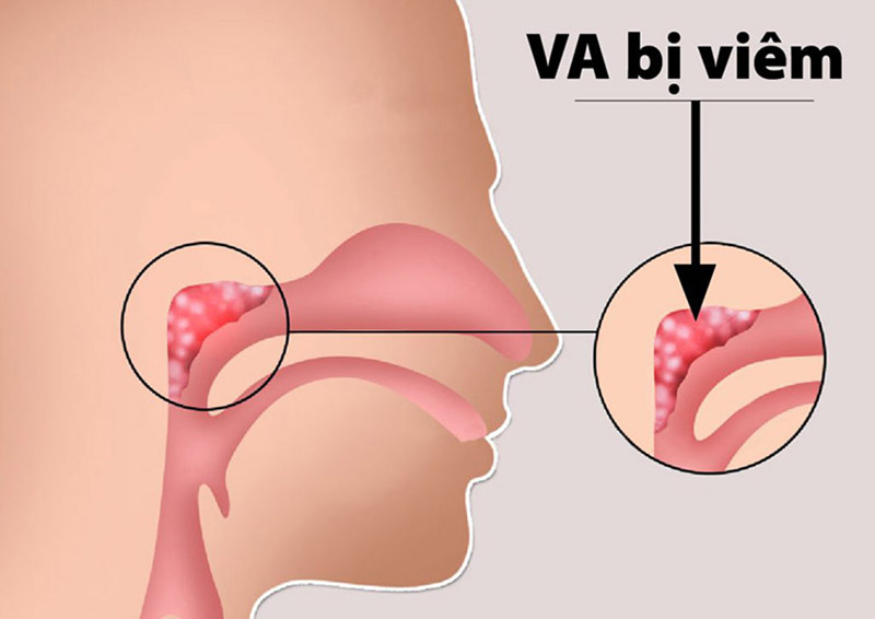 VA là một tổ chức Lympho nằm ở phía sau cửa mũi sau