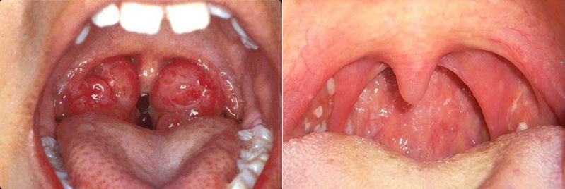 Viêm VA và ung thư vòm họng có những triệu chứng giống nhau