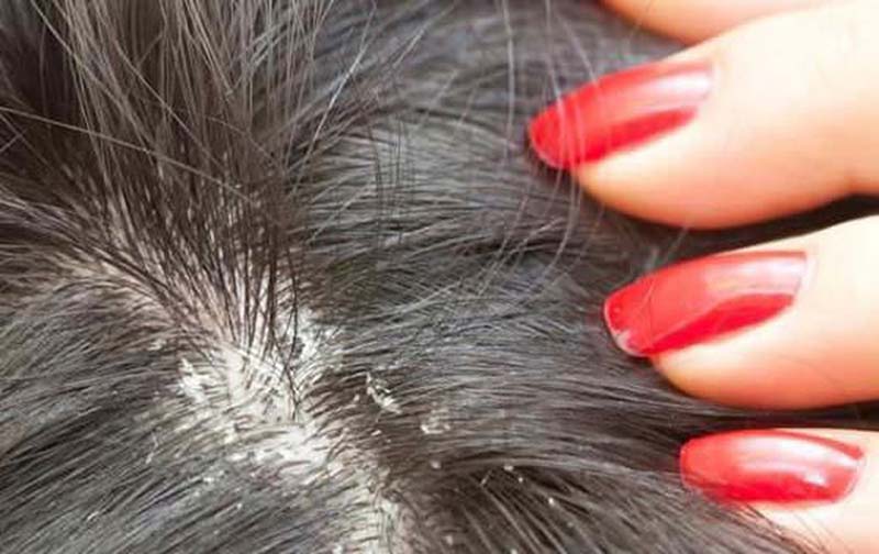 Nấm da đầu là một dạng viêm nhiễm ở vùng da đầu và nang tóc do nấm gây ra