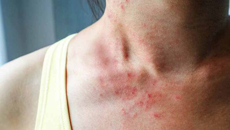 Người bệnh ngứa da có thể bị nhiễm khuẩn, lở loét, sưng đỏ hoặc xuất hiện mủ