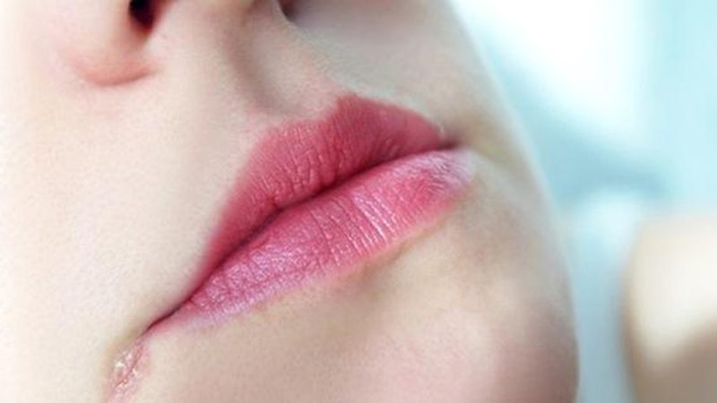 herpes sinh dục môi