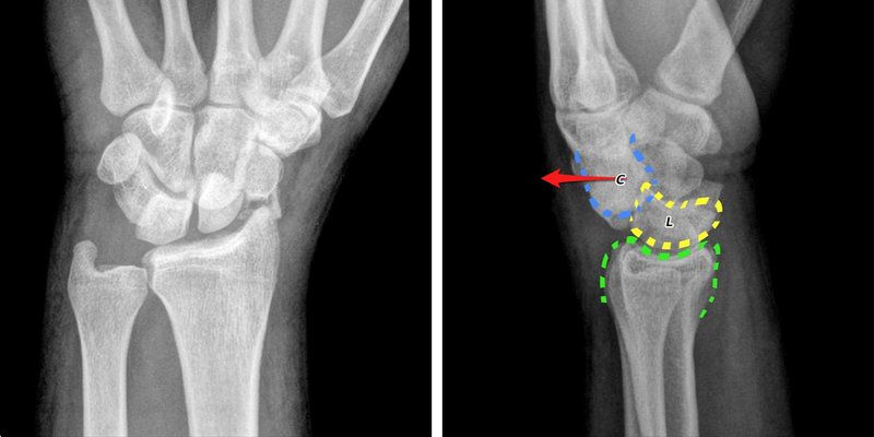 Kiểm tra tình trạng gai xương cổ tay bằng chẩn đoán hình ảnh