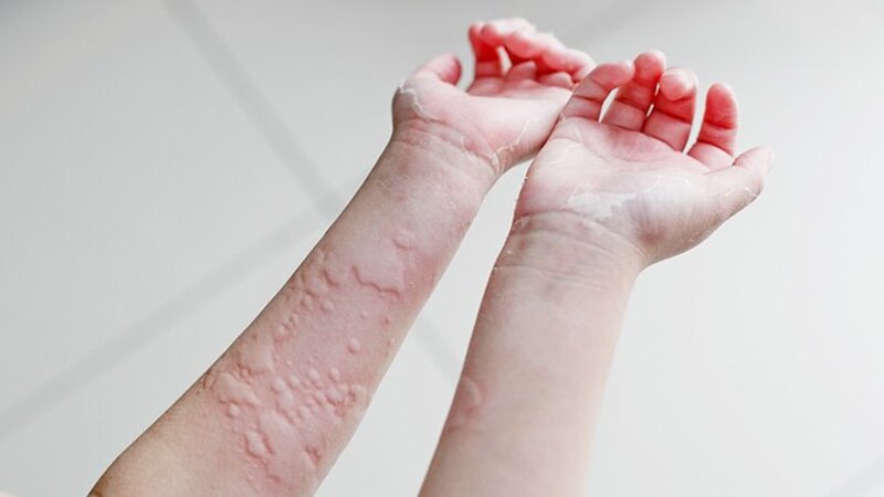 Nổi mề đay, mẩn ngứa trên da là triệu chứng mà những hầu hết người nhiễm biến chủng Omicron đang gặp phải