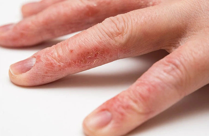 Bệnh chàm đặc trưng bởi các biểu hiện như da bị ửng đỏ, sau đó bong tróc