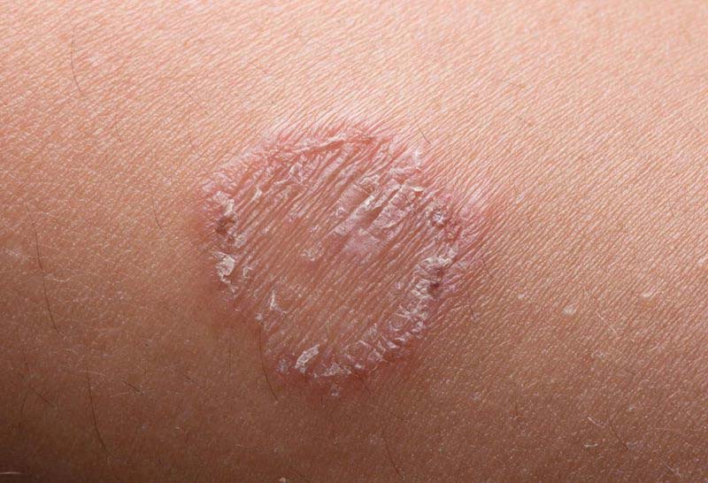 Chàm đồng tiền có thể gây ngứa loét da cùng nhiều triệu chứng khác