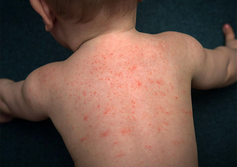 Trẻ nhỏ bị sốt phát ban có thể nổi mẩn đỏ khắp lưng