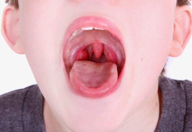 Viêm mũi họng xuất tiết có biểu hiện nghẹt mũi, chảy nước mũi