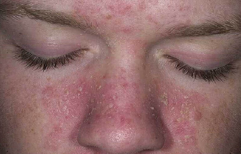 Da mặt bị khô sần và ngứa khiến người bệnh khó chịu và mất tự tin