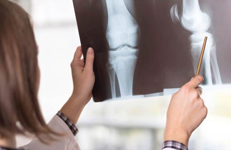 Thông qua phim chụp X-quang bác sĩ có thể thấy được những thay đổi bên trong khớp