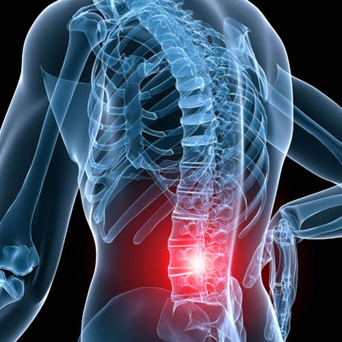 Thoái hóa cột sống thắt lưng gây tổn thương đau nhức nặng