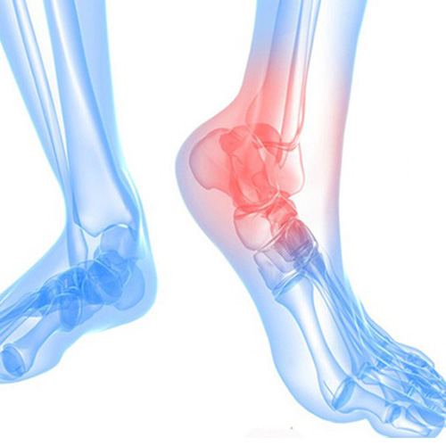 Bệnh thoái hóa khớp cổ chân là tổn thương sụn và xương dưới sụn