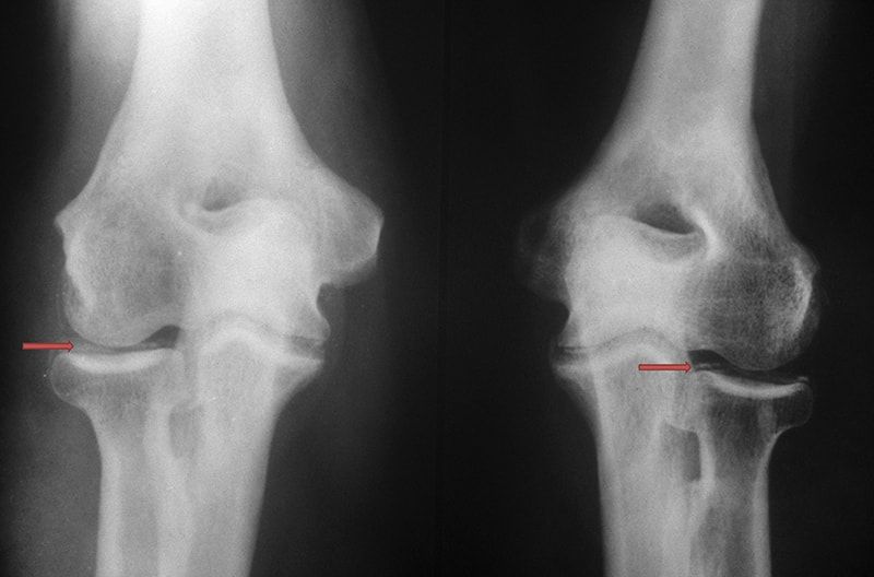 Hình ảnh đầu gối bị thoái hóa thông qua phim chụp X-quang