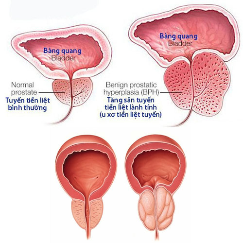 u-xo-tuyen-tien-liet-6