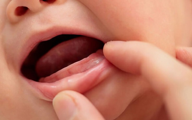 Trẻ chậm mọc răng là vấn đề khá phổ biến