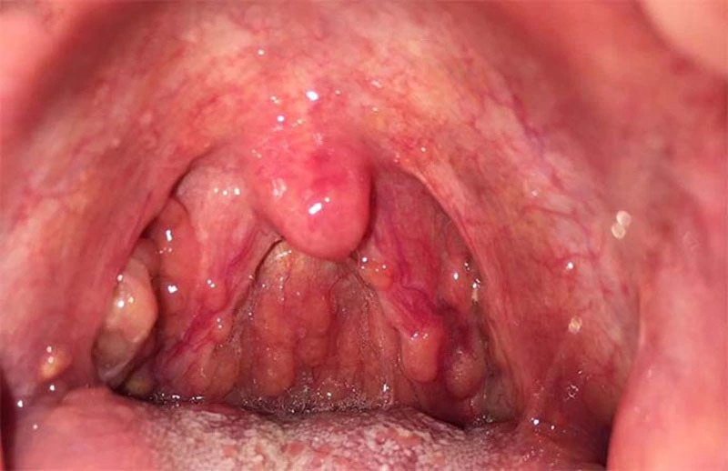 Viêm họng hạt là tình trạng vùng niêm mạc tại khoang họng bị viêm nhiễm