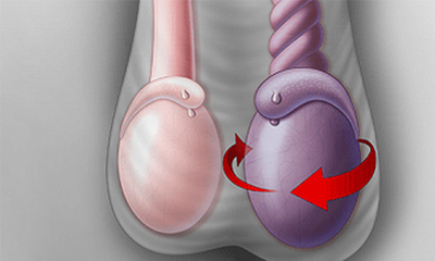 Xoắn Tinh Hoàn: Nguyên Nhân, Biểu Hiện Và Cách Điều Trị