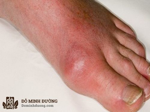 Ngón chân cái bị sưng nhức do mắc bệnh gút