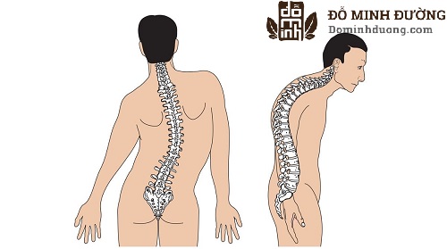 Triệu chứng thoái hóa cột sống thắt lưng gây nhiều biến chứng nguy hiểm
